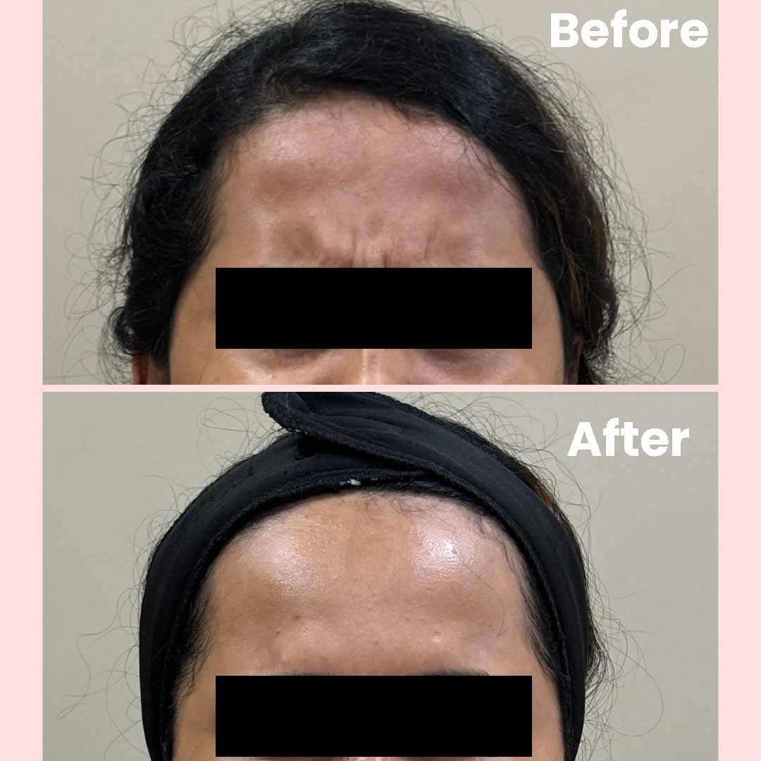 Before-After of Botox Treatemt
