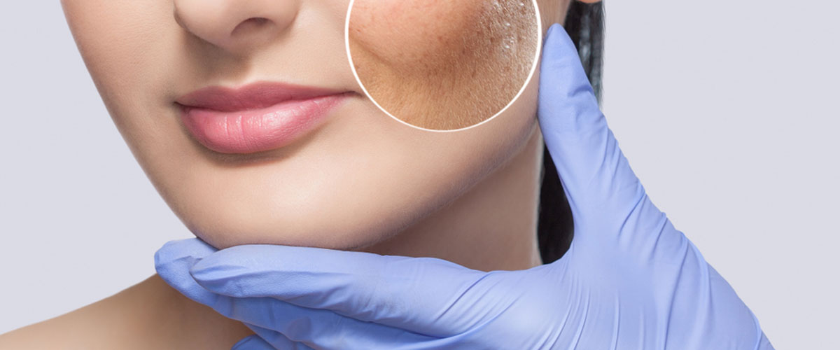 Acne and Acne Scar treatment in Mumbai by Dr. Gunjan Gangaraju