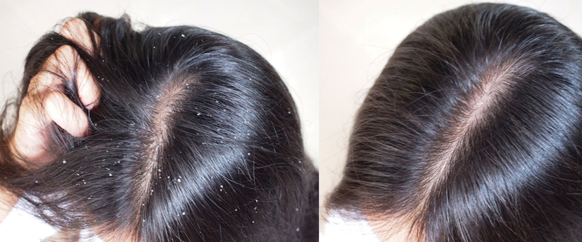 Anti Dandruff treatment in Mumbai by Dr. Gunjan Gangaraju