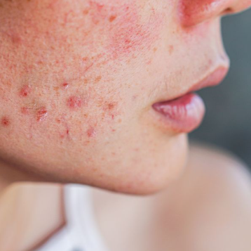 Treatment of acne scar in Mumbai by Dr. Gunjan Gangaraju : Common causes of acne scar