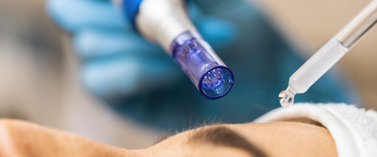 Microneedling treatment in , Navi Mumbai by Dr. Gunjan Gangaraju