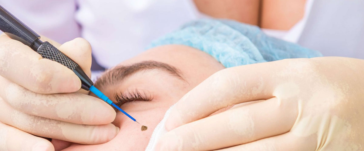 Skin Tag, Wart and Mole Removal Treatment in Mumbai by Dr. Gunjan Gangaraju