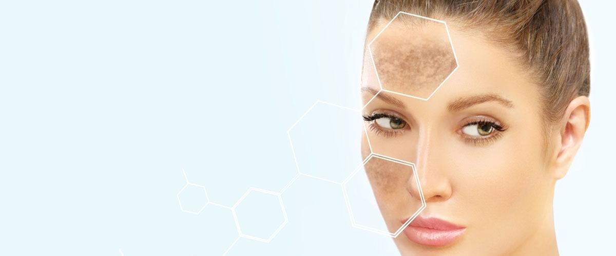 Pigmentation treatment in Mumbai by Dr. Gunjan Gangaraju