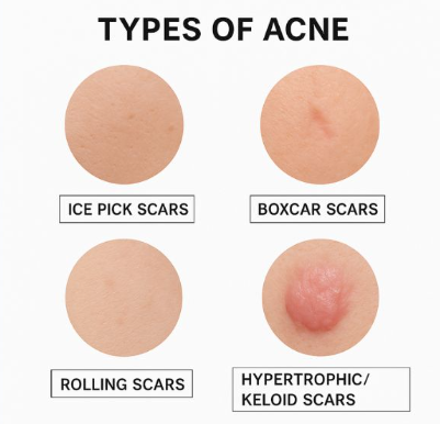 Treatment of acne scar in Mumbai by Dr. Gunjan Gangaraju : Types of acne scar